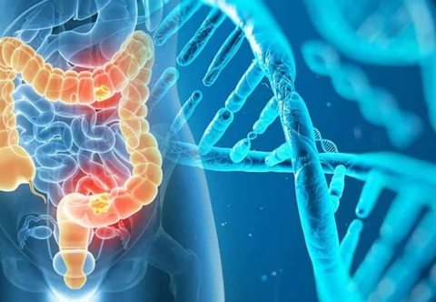 Ung thư đại tràng có di truyền không